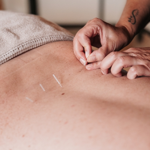 Akupunktør placerer nåle i ryggen under behandling hos Klinik MasAku i Odense