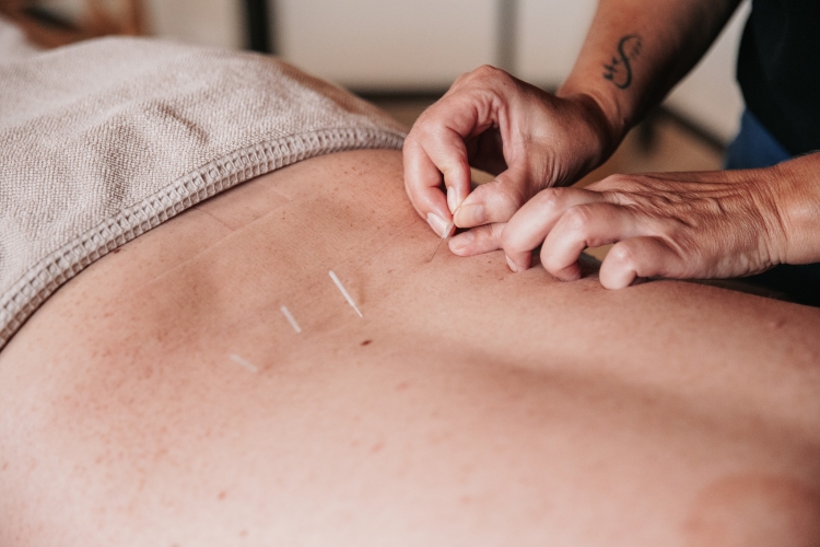 Akupunktør placerer nåle i ryggen under behandling hos Klinik MasAku i Odense